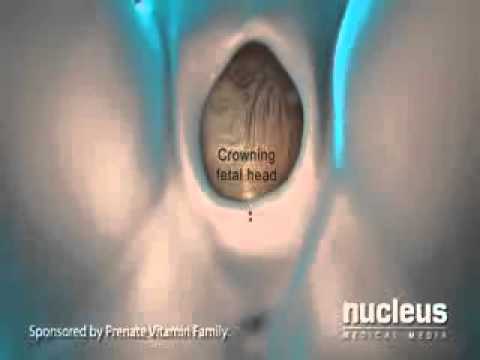 Thumbnail for Episiotomy during Childbirth Delivery